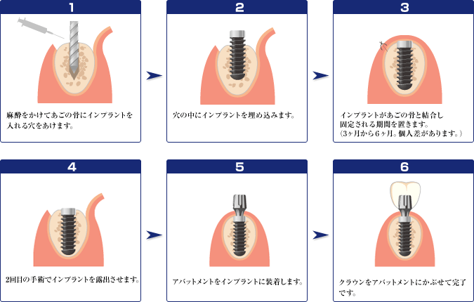 1、麻酔をかけてあごの骨にインプラントを入れる穴をあけます。 2、穴の中にインプラントを埋め込みます。 3、インプラントがあごの骨と結合し固定される期間を置きます。（3ヶ月から6ヶ月。個人差があります。） 4、2回目の手術でインプラントを露出させます。 5、アバットメントをインプラントに装着します。 6、クラウンをアバットメントにかぶせて完了です。